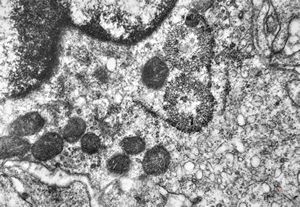 M,41y. | hairy cell leukemia - spleen - ribosome-lamella complex in tricholeukocyte M,41y. | hairy cell leukemia - spleen - ribosome-lamella complex in tricholeukocyte